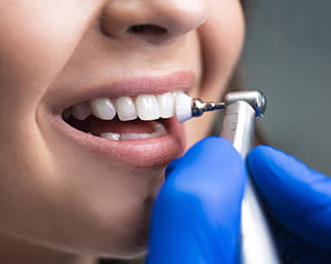 PMTC（Professional Mechanical Tooth Cleaning） イメージ