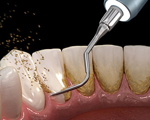 SPTⅡ（Supportive Periodontal Therapy） イメージ